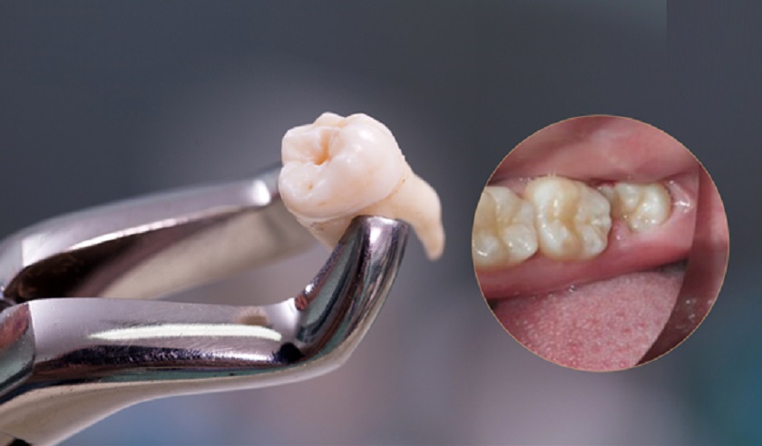 Bác sĩ có thể chỉ định nhổ răng số 8 trước khi niềng răng