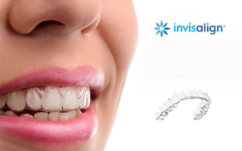 Lựa chọn niềng răng trong suốt để đảm bảo tối đa tính thẩm mỹ