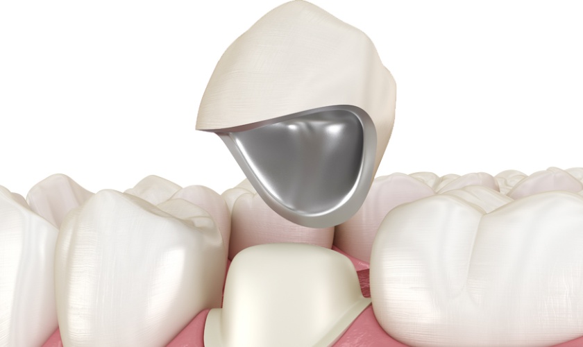 Trường hợp bọc mão sứ đơn lẻ thì có thể thực hiện niềng răng