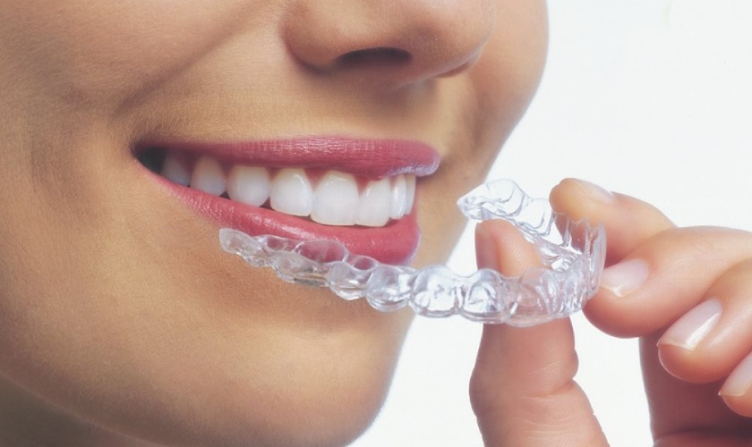 Niềng răng trong suốt Invisalign sở hữu nhiều ưu điểm vượt trội