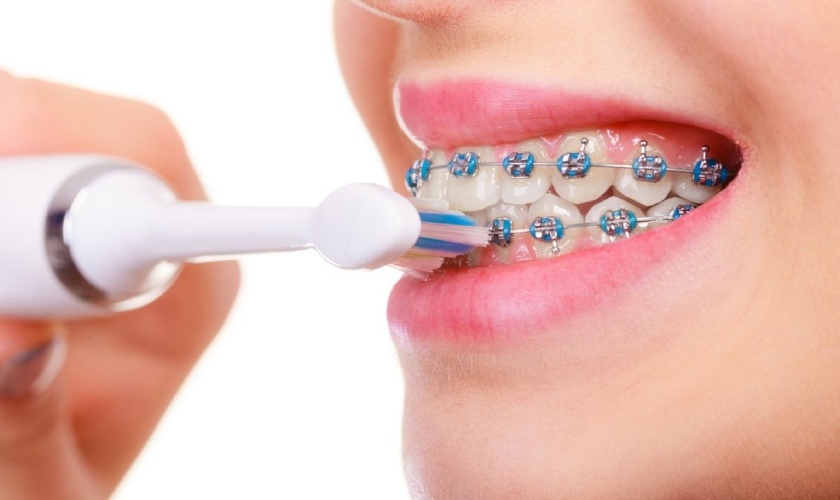 Cần chăm sóc răng miệng đúng cách khi niềng răng sứ