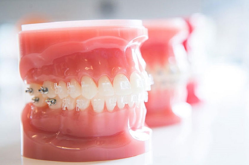Tìm hiểu thời gian, chi phí và cơ sở nha khoa trước khi niềng