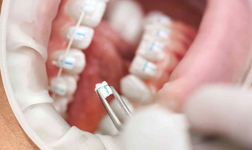 Niềng răng mắc cài sứ được rất nhiều người ưa chuộng