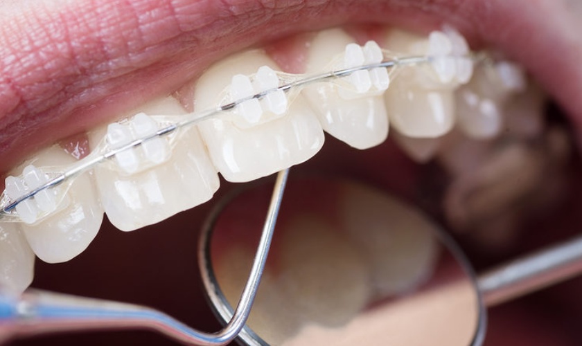 Niềng răng mắc cài sứ tự khóa mang lại hiệu quả niềng răng cao