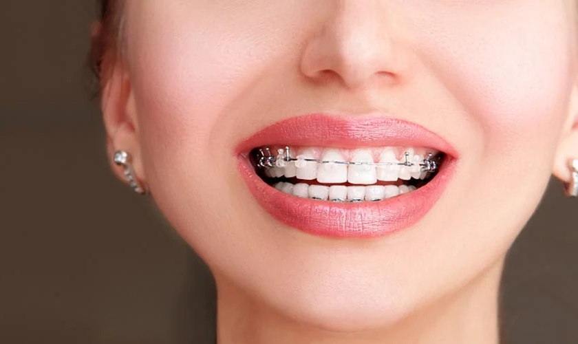 Niềng răng sứ thẩm mỹ sở hữu nhiều ưu điểm vượt trội