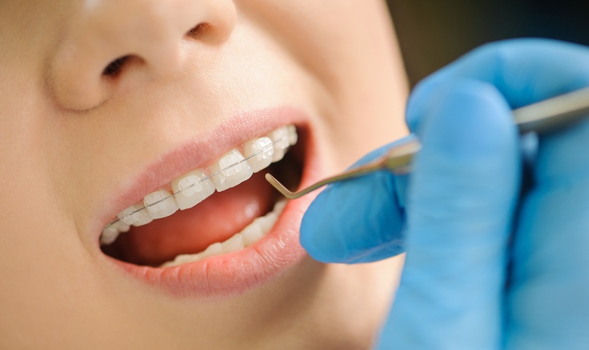 Niềng răng sứ thẩm mỹ - Giải pháp cho hàm răng đều đẹp