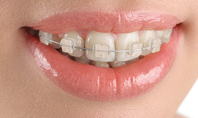 Niềng răng mắc cài sứ mang lại vẻ đẹp thẩm mỹ cho khách hàng