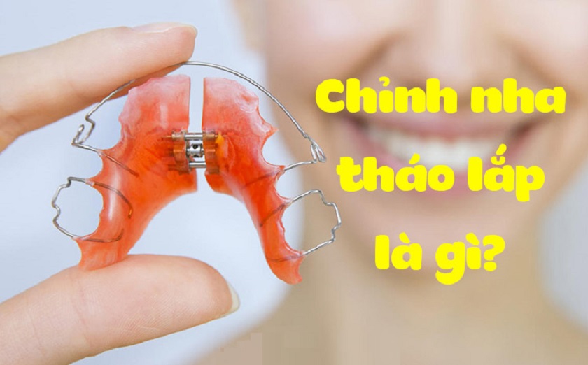 Niềng răng tháo lắp là gì?