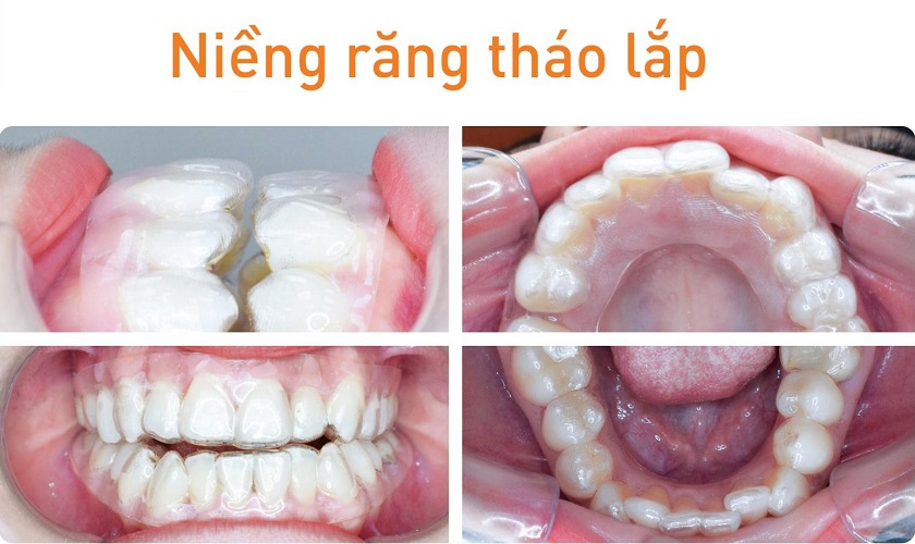 Niềng răng tháo lắp – khái niệm, chỉ định và cách phân loại