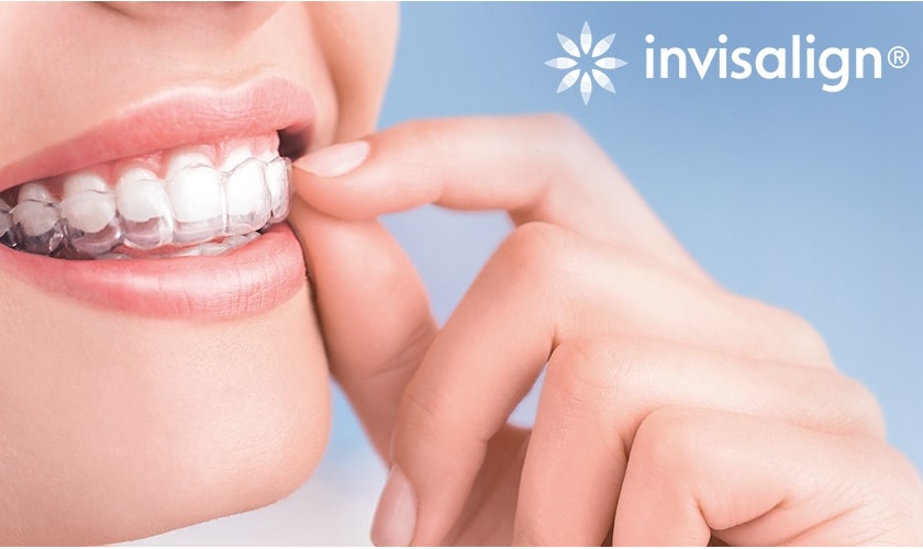 Niềng răng trong suốt Invisalign