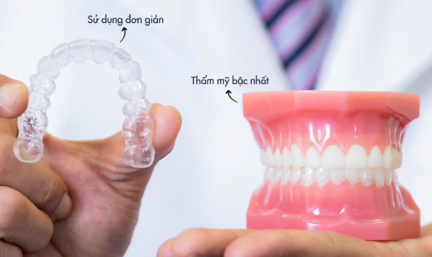 Niềng răng Invisalign mang đến nhiều ưu điểm vượt trội