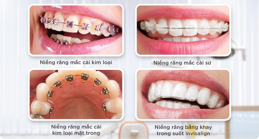 Thời gian niềng răng thưa phụ thuộc vào loại khí cụ chỉnh nha