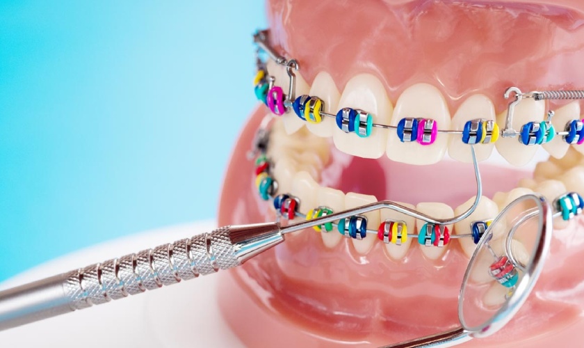 Niềng răng thun màu nào đẹp nhất?