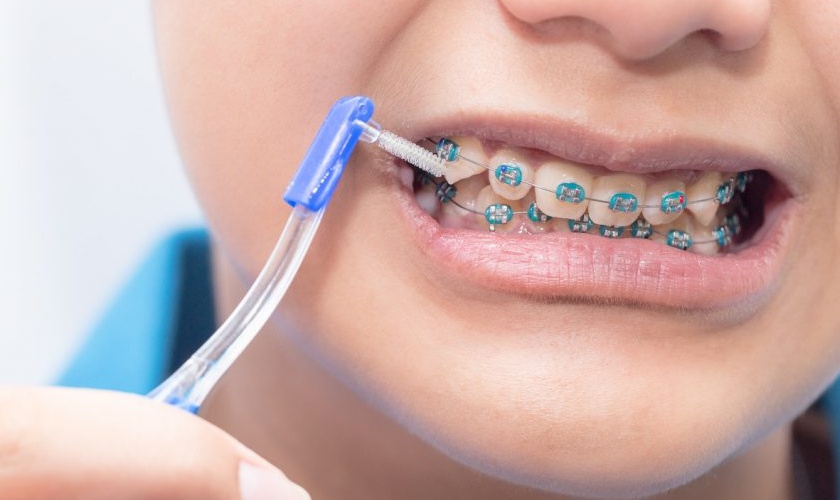 Cần vệ sinh răng miệng sạch sẽ khi niềng răng
