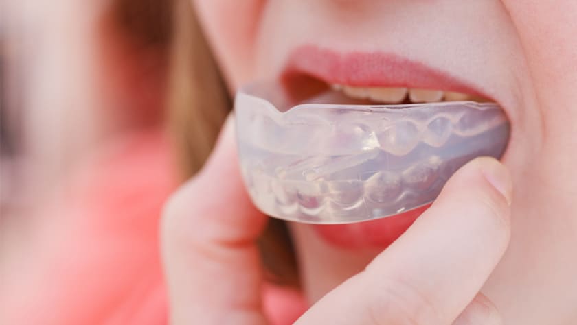 Niềng răng trainer là kỹ thuật chỉnh nha giúp sửa chữa răng bằng các khay silicon an toàn