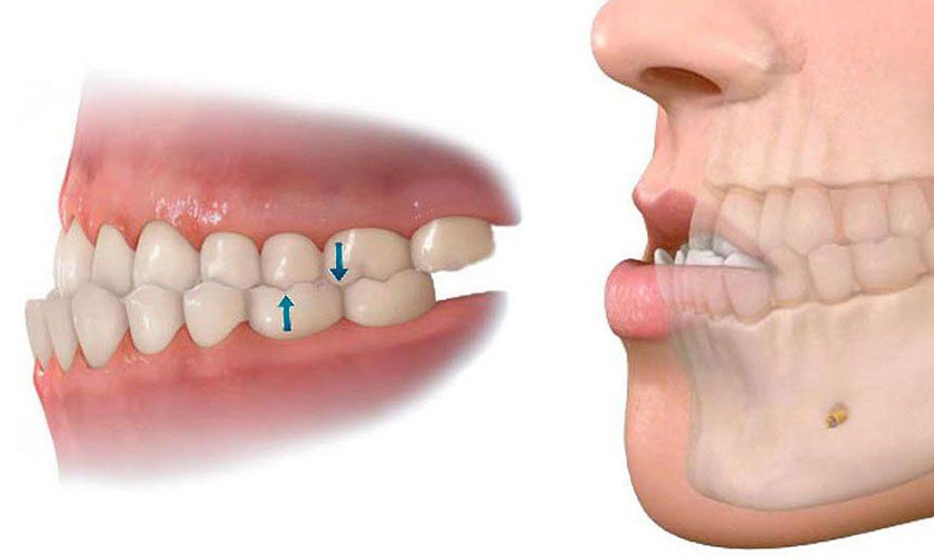 Răng móm có thể cải thiện với niềng răng trong suốt