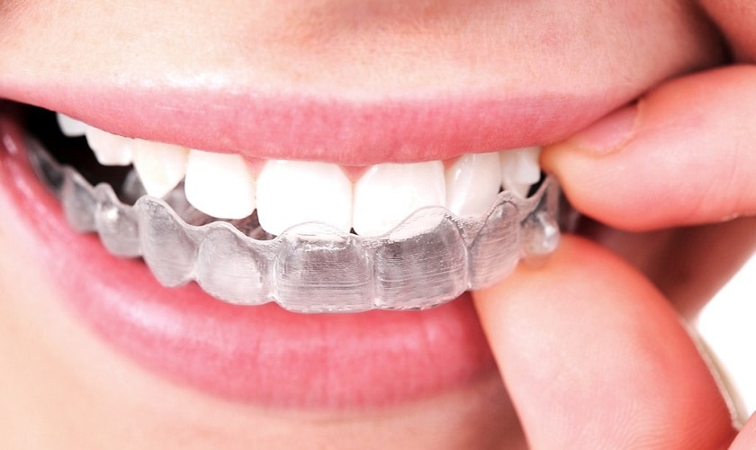 Niềng răng trong suốt Invisalign là gì? Ưu điểm và thời gian