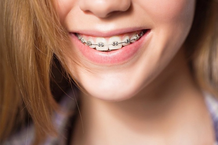 Mức độ sai lệch răng là một yếu tố quyết định niềng răng bao lâu