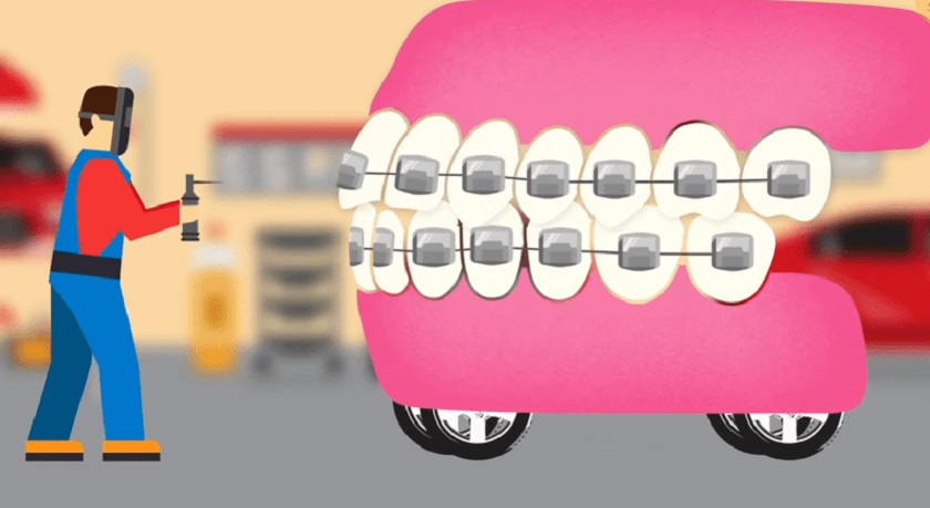 Quá trình niềng răng hô nhổ răng có gây nguy hiểm không?