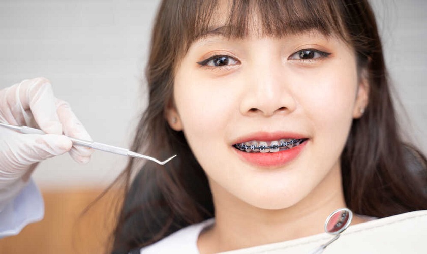 Quá trình niềng răng hô nhổ răng và những điều cần biết