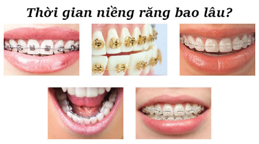 Quá trình niềng răng mất bao nhiêu thời gian
