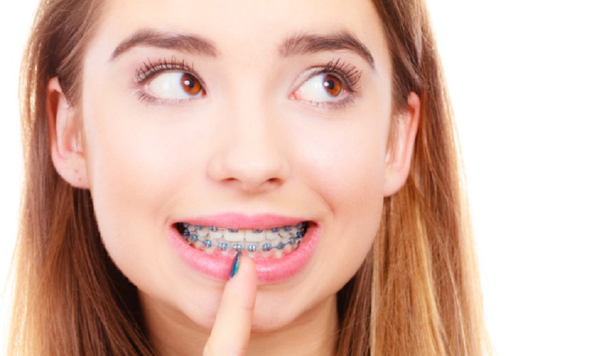 Quá trình niềng răng trải qua những giai đoạn nào?