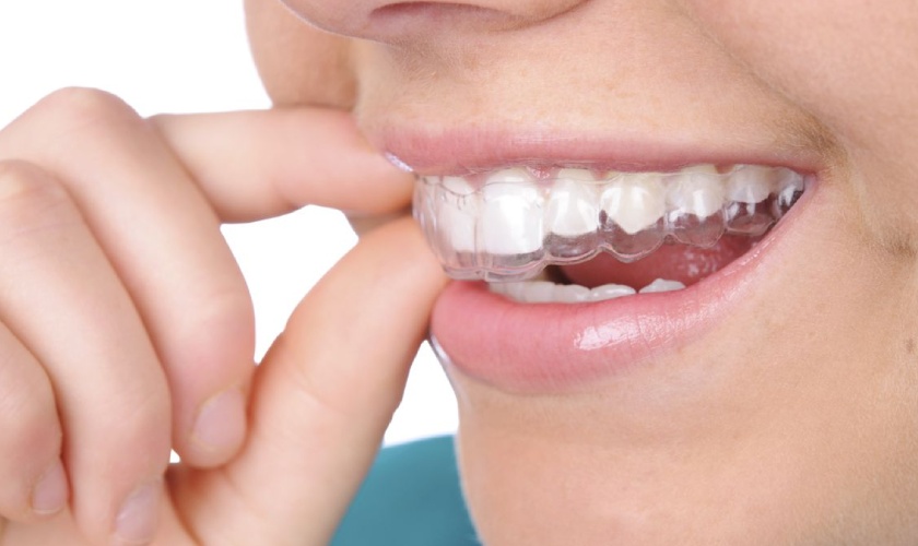 Quy trình niềng răng trong suốt tại Nha khoa Nhân Tâm