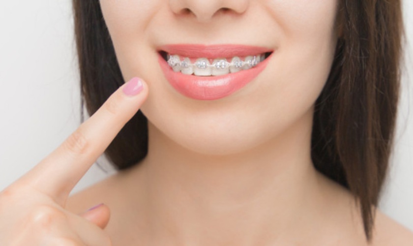 Niềng răng là giải pháp tối ưu trong việc khắc phục răng cửa mọc lệch hàm trên