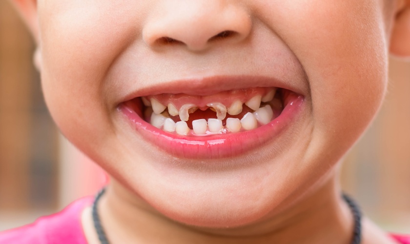 Răng lệch lạc dễ gây nên tình trạng sâu răng ở trẻ