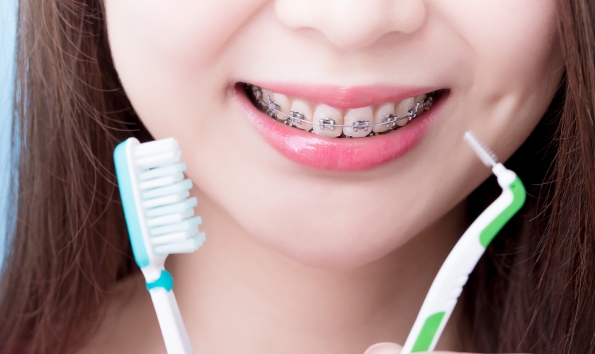 Cần vệ sinh răng miệng kỹ lưỡng khi niềng răng