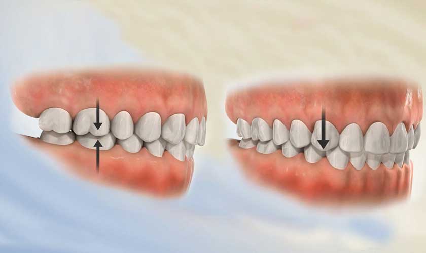 Sai lệch khớp cắn làm tăng nguy cơ mắc sâu răng