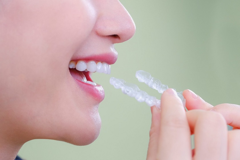 Niềng răng Invisalign giúp dễ dàng vệ sinh và ăn uống, giảm nguy cơ sâu răng