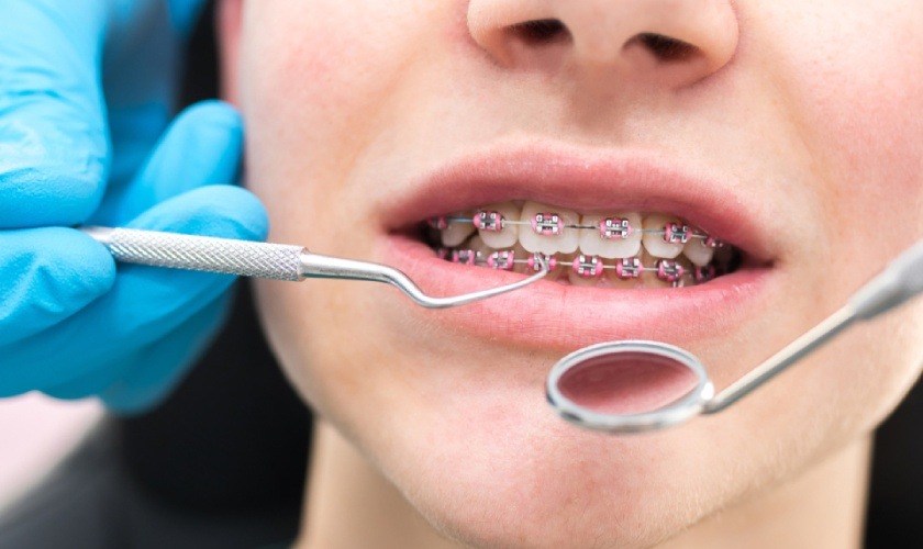 Tác hại của niềng răng có nguy hiểm không?