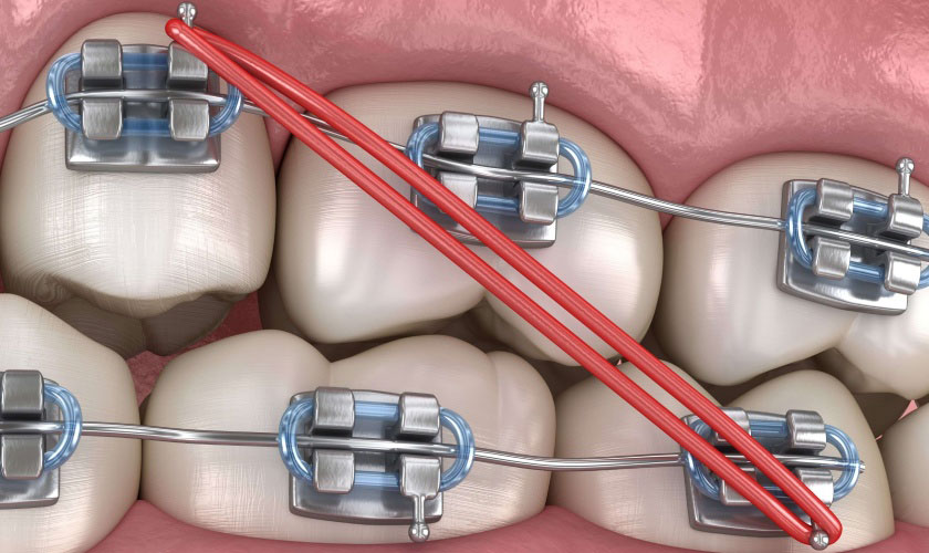 Thun niềng răng là gì là thắc mắc được nhiều người quan tâm