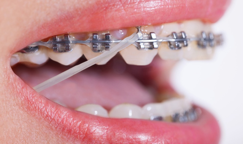 Thun niềng răng giúp tạo lực kéo giúp răng dịch chuyển nhanh chóng và hiệu quả