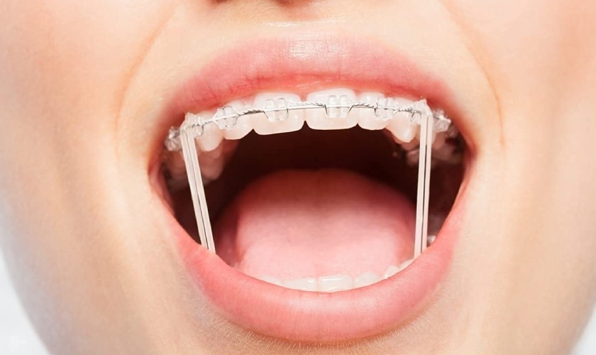 Cần phải quan tâm đến những lưu ý khi đeo thun niềng răng