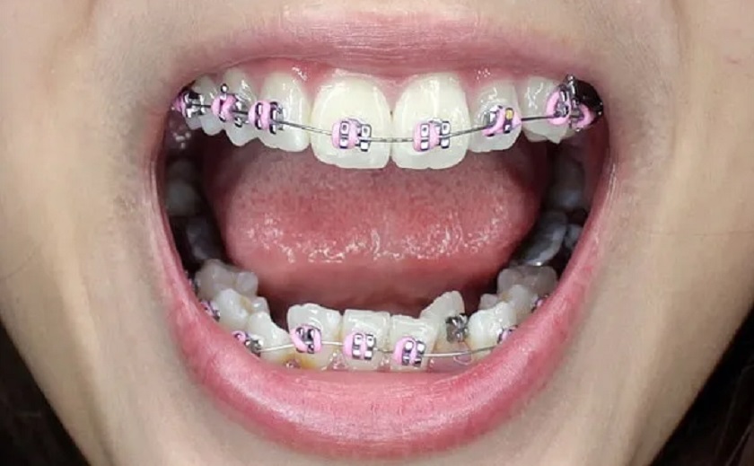 Mức độ sai lệch răng sẽ quyết định niềng răng nhanh nhất là bao lâu