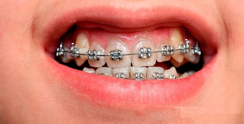 Răng tiếp tục di chuyển trong tháng thứ 6 – 9 của quá trình chỉnh nha