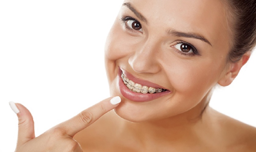 Thời gian niềng răng thường kéo dài bao lâu?