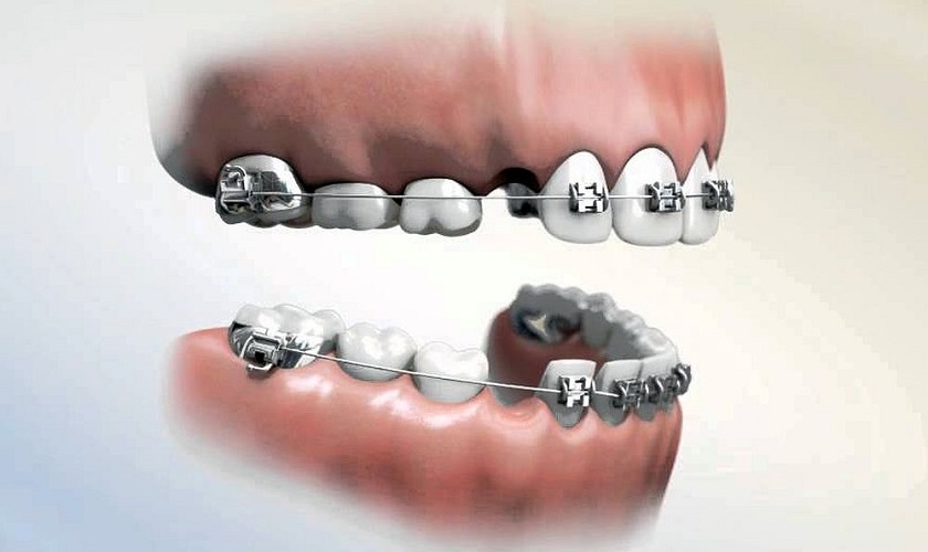 Nhổ răng là cần thiết trong một số trường hợp niềng răng hô