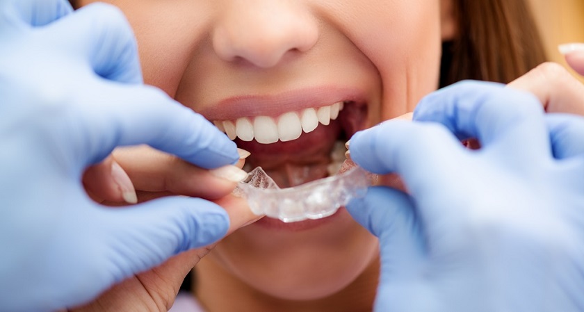 Niềng răng Invisalign hoạt động như thế nào?