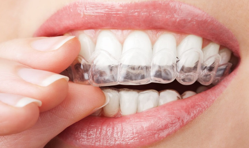 Tìm hiểu về niềng răng trong suốt Invisalign