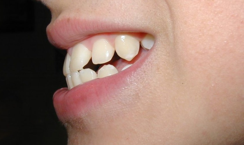 Răng hô khiến khuôn mặt mất thẩm mỹ