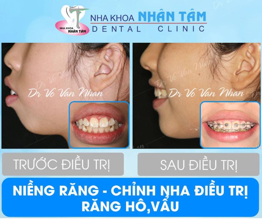 Hình ảnh khách hàng trước và sau khi niềng răng hô tại Nha khoa Nhân Tâm