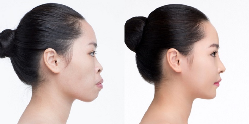 Gương mặt trước và sau khi niềng răng có sự thay đổi lớn