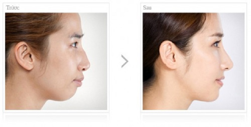 Sự thay đổi mũi, cằm trước và sau khi niềng răng