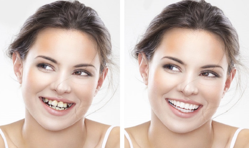 Trước và sau khi niềng răng khuôn mặt thay đổi như thế nào?