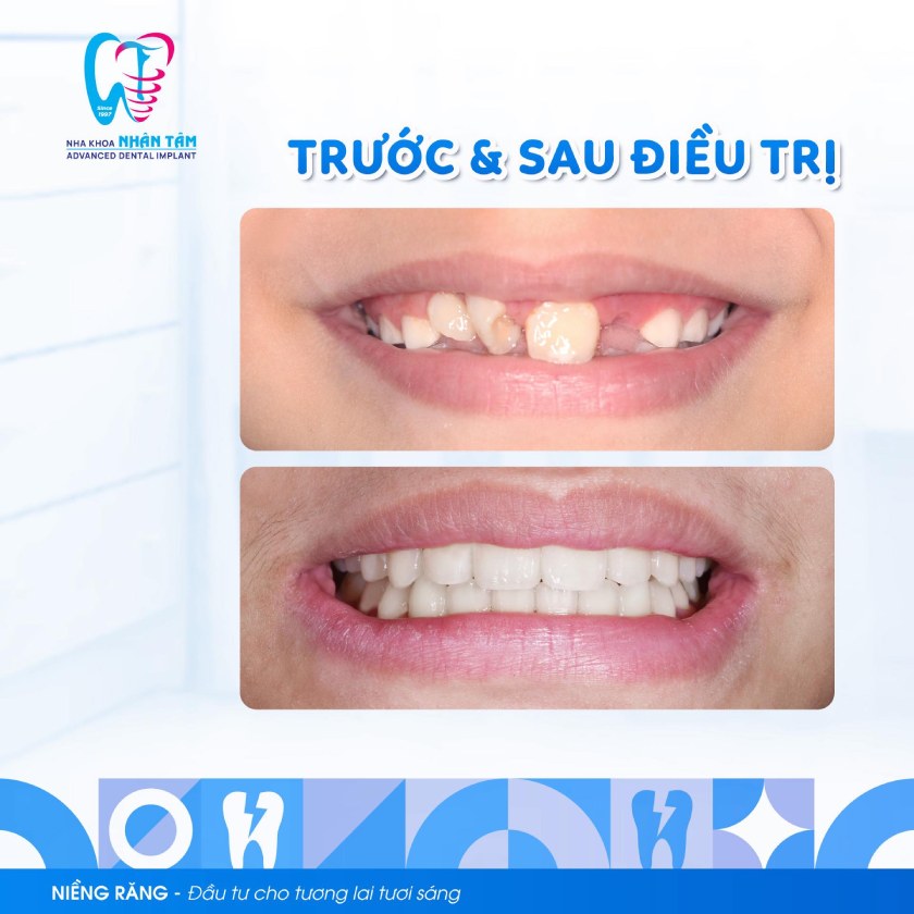 Khách hàng niềng răng tại Nha khoa Nhân Tâm