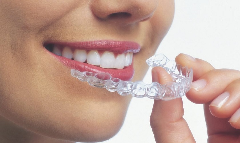 Vì sao giá niềng răng trong suốt cao hơn phương pháp khác?