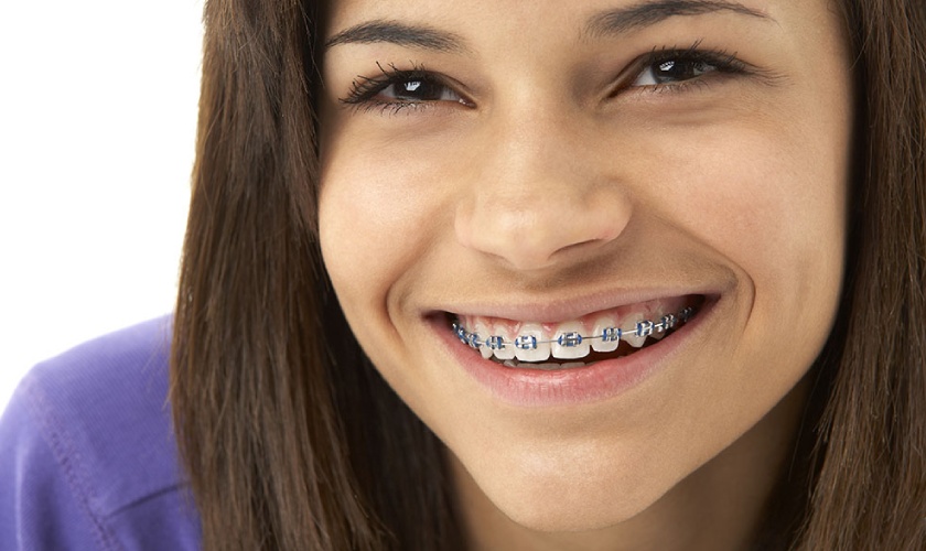 Niềng răng mắc cài kim loại phù hợp với hầu hết các sai lệch của răng